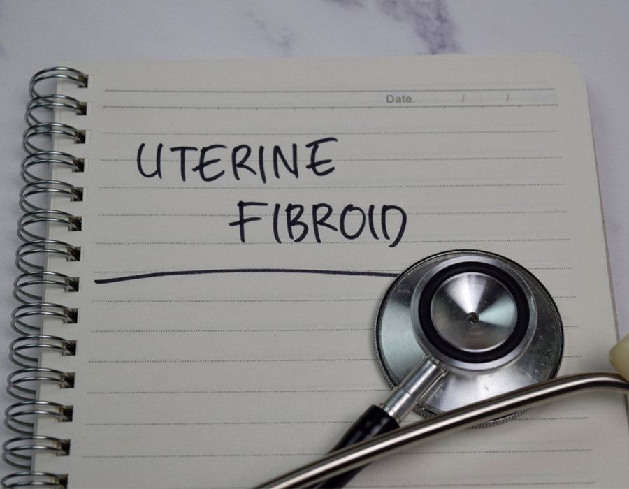 Uterine Fibroid blog post