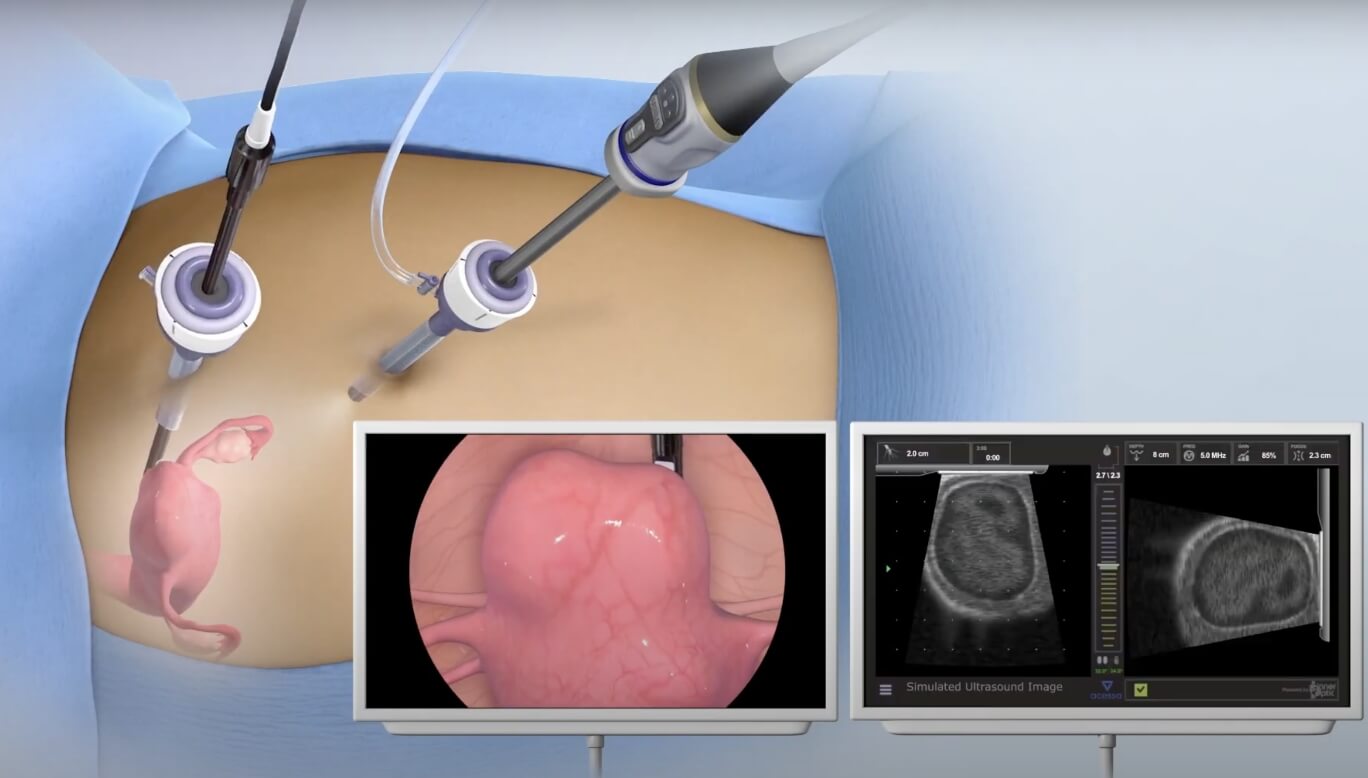 You are currently viewing Minimally Invasive Approach  Treats Fibroids